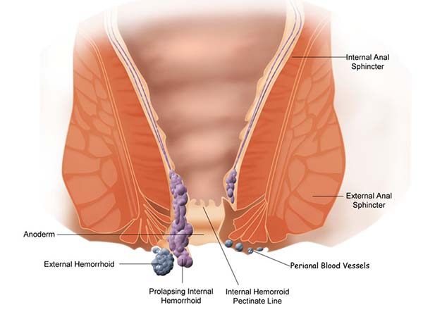 Piles, Haemorroids: Symptoms, Causes, and Diet Treatments